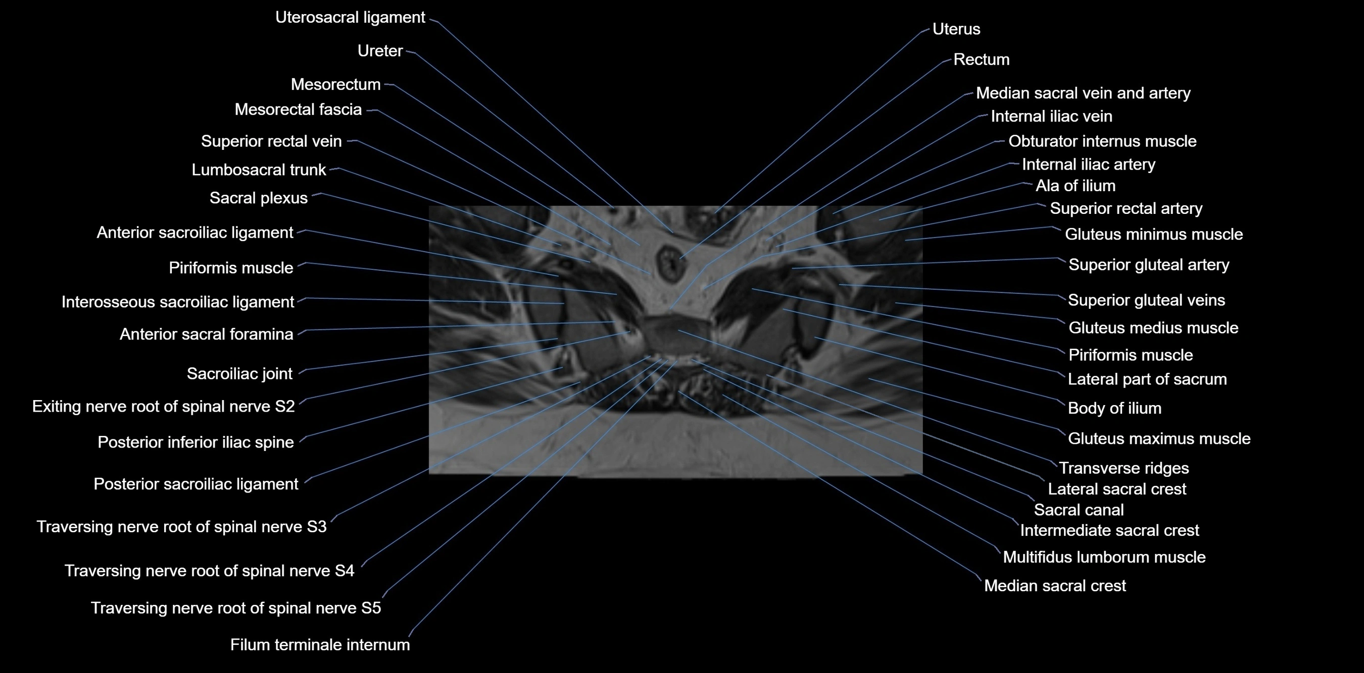MRI sacrum, coccyx and sacroiliac joint axial cross sectional anatomy 3T  radiology  image-img-00001-00034.webp